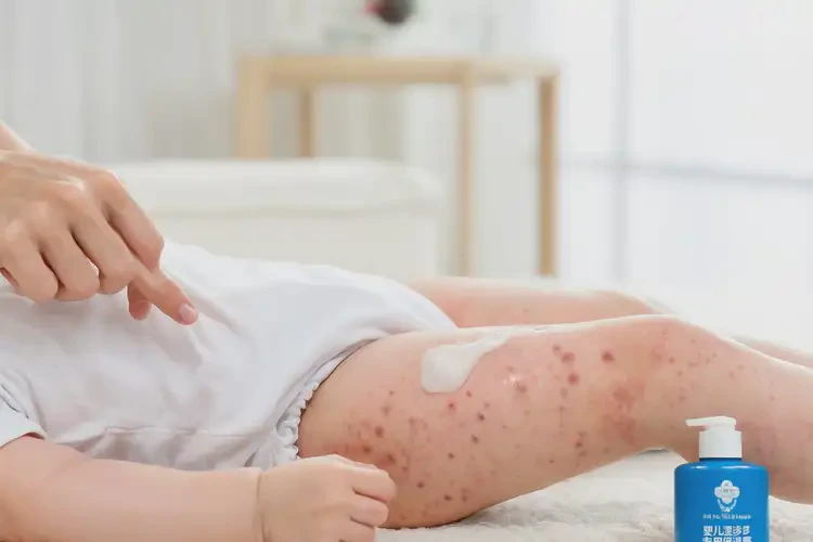 寶寶大腿容易起濕疹不管它會自己痊愈嗎(圖1)