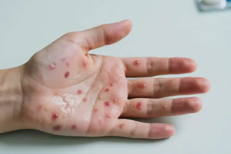 青少年手上經(jīng)常起濕疹不管它會自己好嗎(圖4)