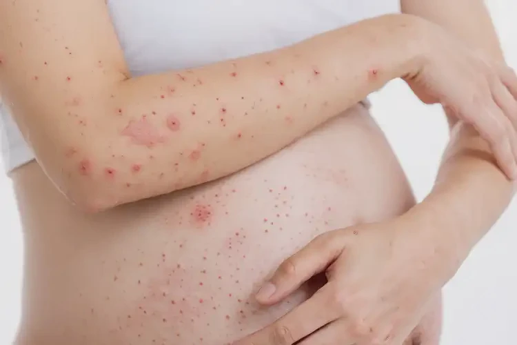 孕妇屁股上经常长湿疹可以彻底自愈吗(图4)