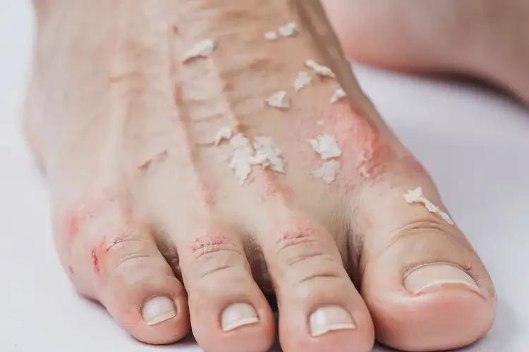 女性腳上出濕疹可以徹底自愈嗎(圖4)