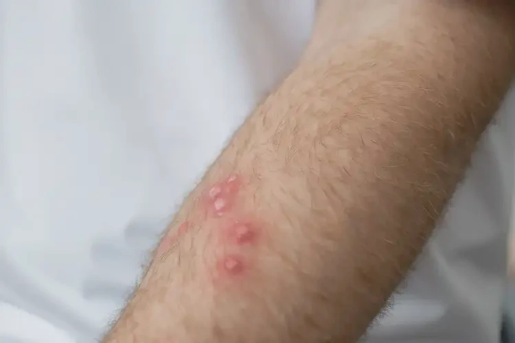 男性手臂有濕疹可以徹底自愈嗎(圖4)