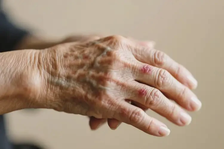 高齡老人手上偶爾長濕疹不管它會自己自愈嗎(圖2)