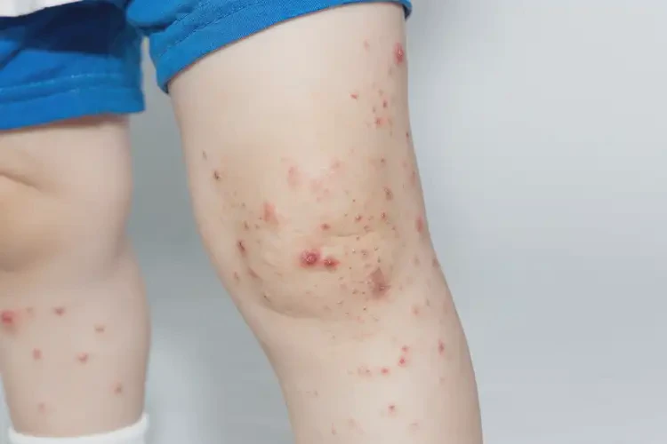 兒童小腿上出現(xiàn)濕疹可不可以徹底自愈(圖2)