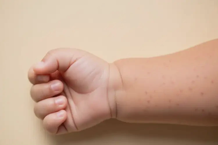 嬰兒手臂上出現(xiàn)濕疹不管它會自己痊愈嗎(圖4)
