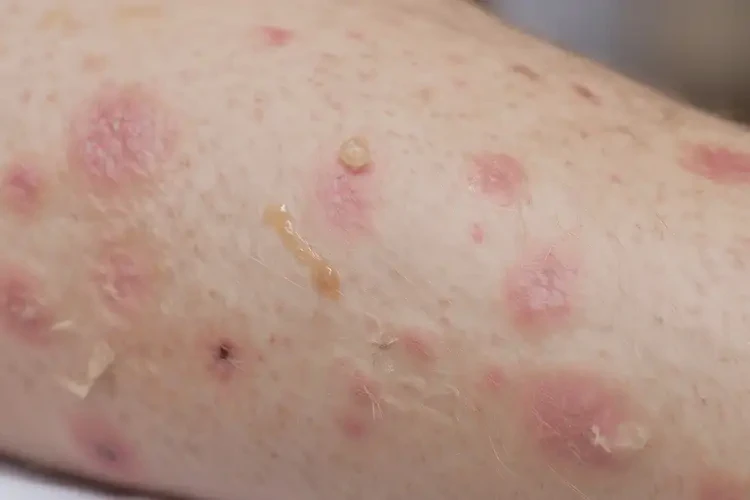 少兒屁股上偶爾長濕疹不管它會自己痊愈嗎(圖2)