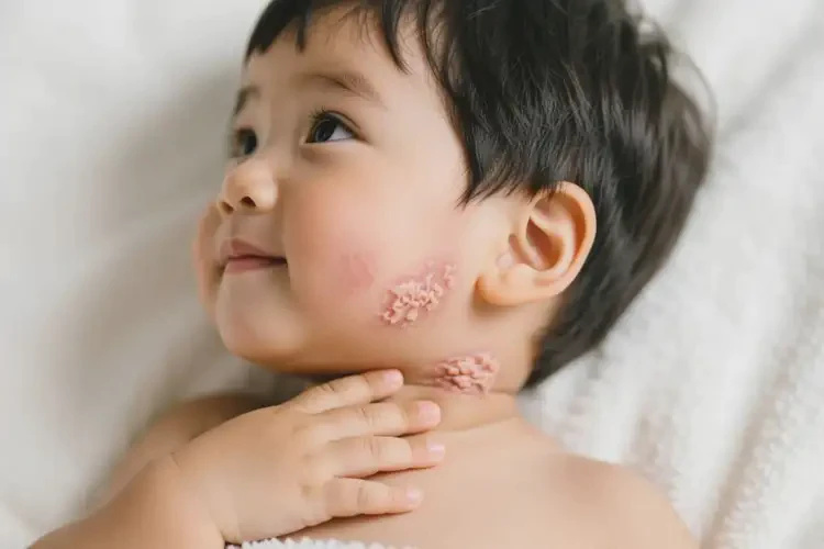 兒童脖子上有濕疹可以徹底自愈嗎(圖2)