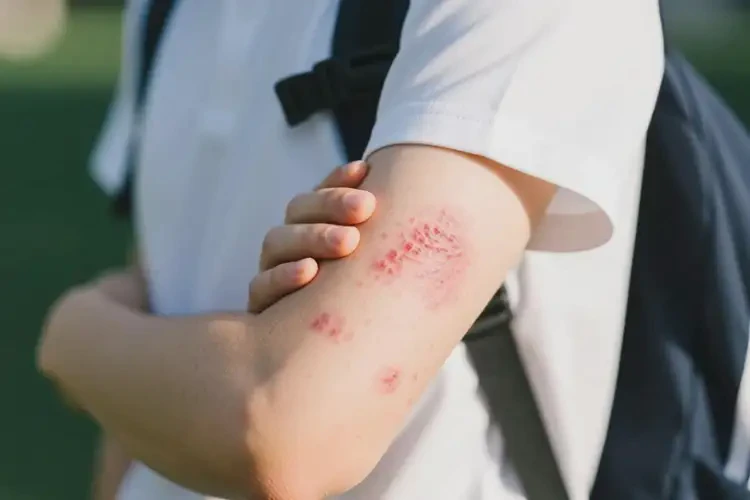 大學生手臂偶爾起濕疹不管它會自己自愈嗎(圖1)