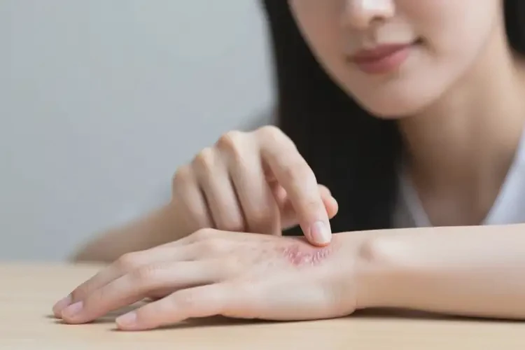 女性手上容易长湿疹能够彻底治愈吗(图3)