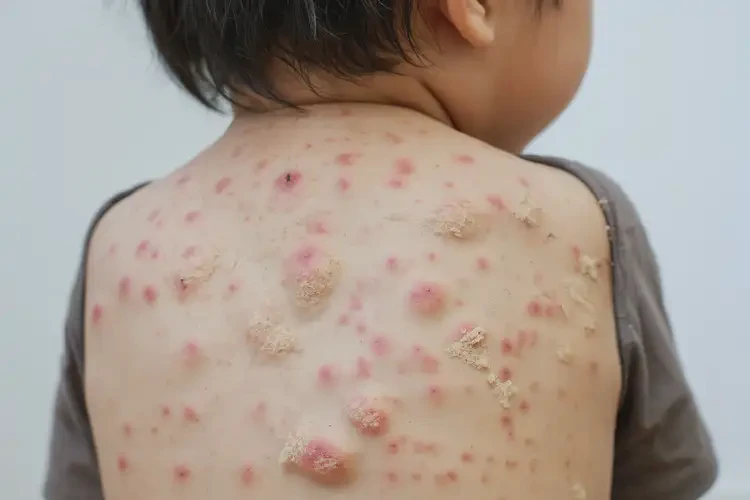 少兒全身起濕疹不管它會自己痊愈嗎(圖4)