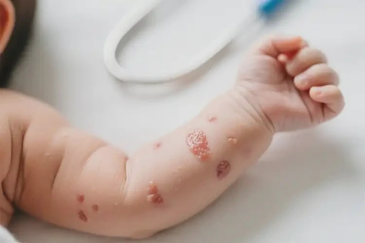 新生兒手臂上經(jīng)常起濕疹不管它會自己痊愈嗎(圖3)