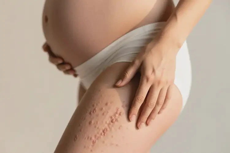 產(chǎn)婦大腿上經(jīng)常長(zhǎng)濕疹不管它會(huì)自己好嗎(圖4)