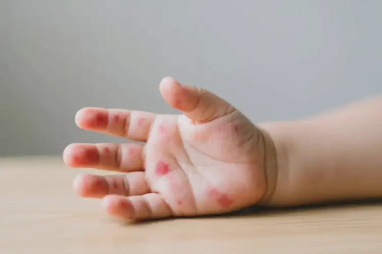 小兒手上出現(xiàn)濕疹可以徹底自愈嗎(圖4)