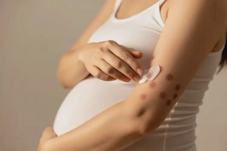 孕婦全身有濕疹能夠徹底治愈嗎(圖2)