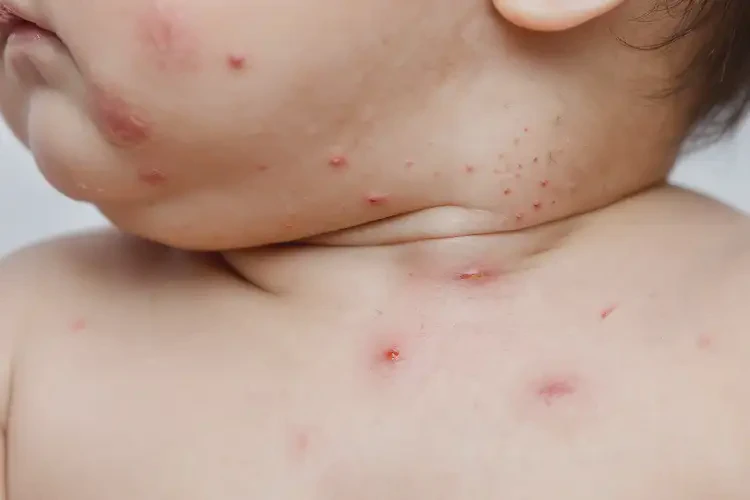 嬰幼兒脖子經(jīng)常長濕疹不管它會(huì)自己自愈嗎(圖4)