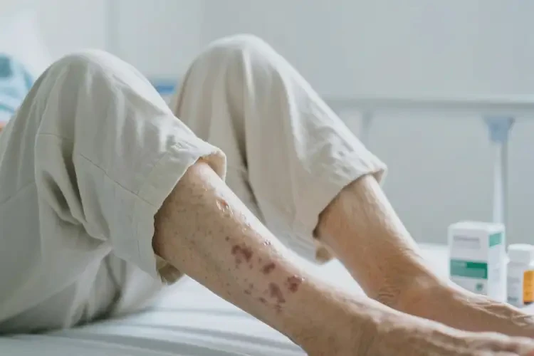 高龄老人大腿偶尔长湿疹不管它会自己好吗(图3)