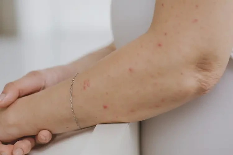 孕婦手臂上經(jīng)常起濕疹不管它會自己自愈嗎(圖4)