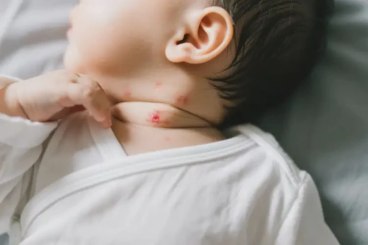 嬰幼兒脖子偶爾長(zhǎng)濕疹不管它會(huì)自己好嗎(圖3)