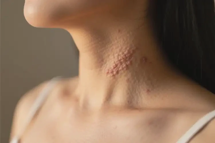 產(chǎn)婦脖子出現(xiàn)濕疹不管它會(huì)自己好嗎(圖1)