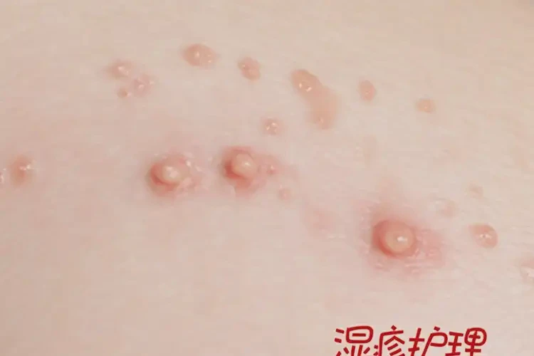 幼兒肛周經(jīng)常起濕疹可不可以徹底自愈(圖4)