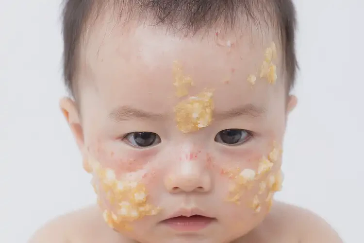 兒童小腿上出現(xiàn)濕疹可不可以徹底自愈(圖3)