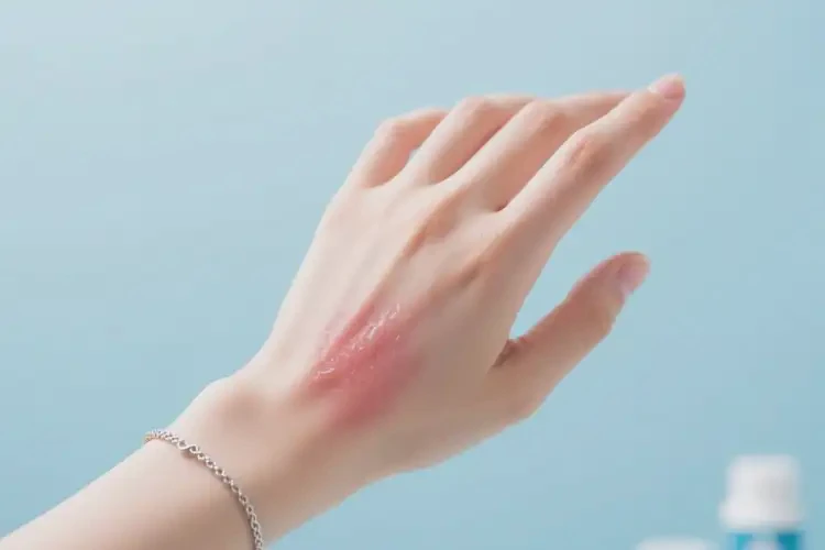 女性手上容易长湿疹能够彻底治愈吗(图2)