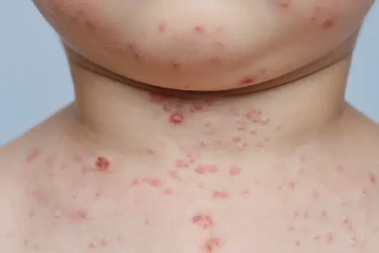 小兒脖子容易起濕疹可以徹底自愈嗎(圖4)