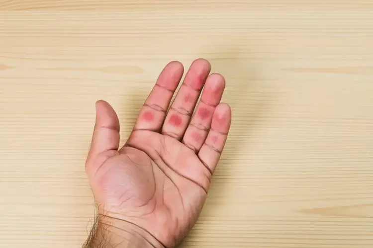 男人手上偶爾起濕疹不管它會自己自愈嗎(圖4)