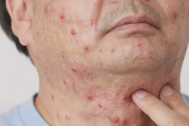 男性脖子上經(jīng)常長濕疹能夠徹底治愈嗎(圖4)