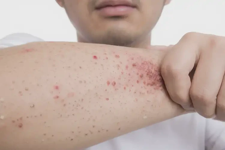 男生身上出現(xiàn)濕疹能靠自己自愈嗎(圖4)