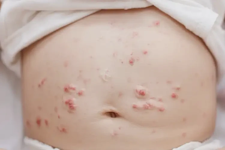幼兒肚子上長(zhǎng)濕疹可以徹底自愈嗎(圖4)