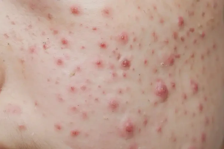 青少年全身長(zhǎng)濕疹不管它會(huì)自己好嗎(圖4)