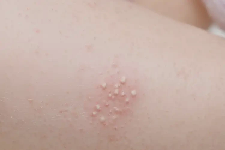 幼兒小腿偶爾長濕疹能徹底自愈嗎(圖4)