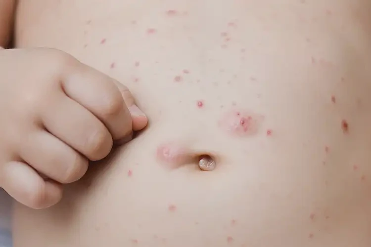 幼兒肚子上出濕疹不管它會(huì)自己痊愈嗎(圖4)