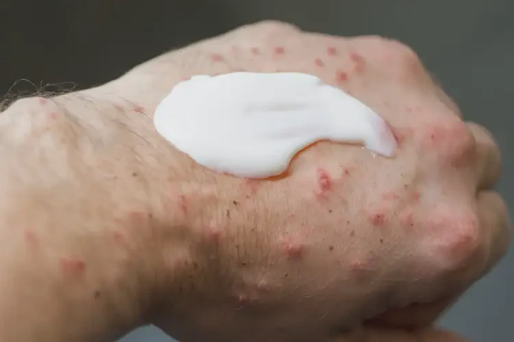 男人手上偶爾起濕疹可不可以徹底自愈(圖3)