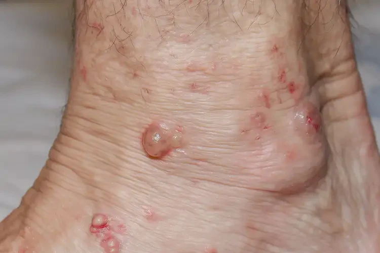 男性腳上出現(xiàn)濕疹不管它會自己好嗎(圖4)