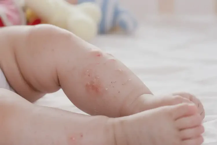 婴幼儿四肢出现湿疹不管它会自己自愈吗(图4)