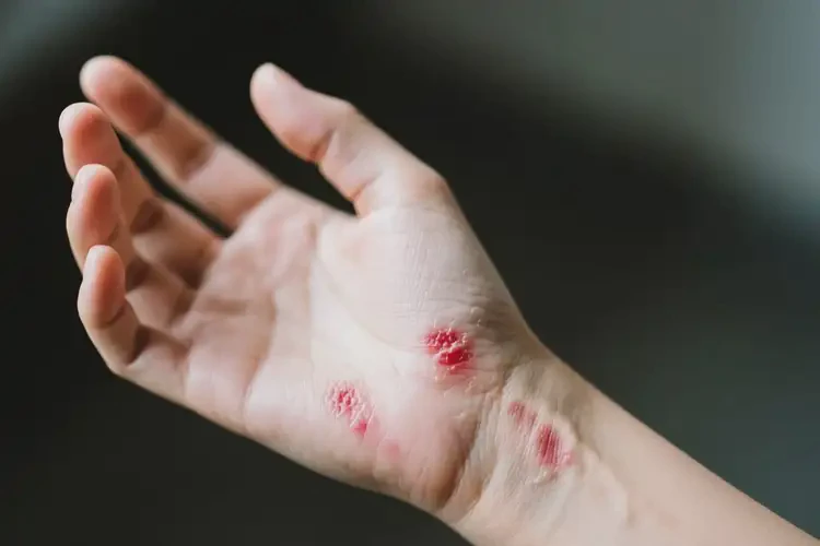 男性手臂上出現(xiàn)濕疹可以徹底自愈嗎(圖2)