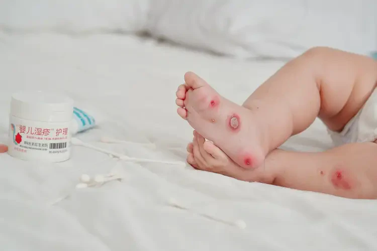寶寶小腿上偶爾起濕疹可不可以徹底自愈(圖4)