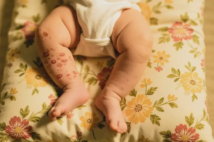 嬰幼兒大腿經(jīng)常長濕疹不管它會自己痊愈嗎(圖2)