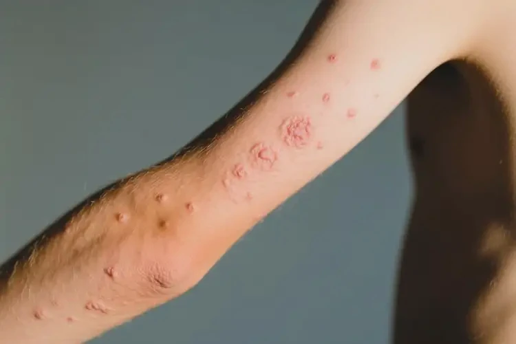 青少年手臂出濕疹不管它會(huì)自己好嗎(圖2)