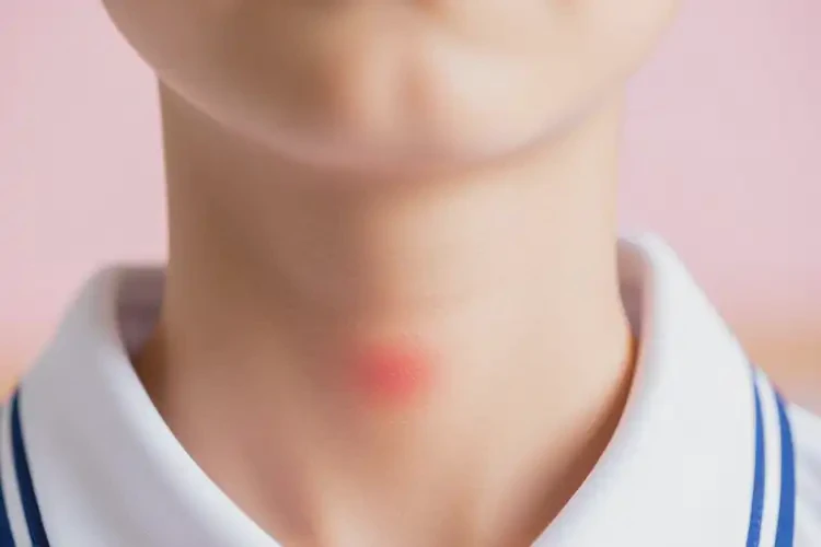 中學(xué)生脖子上長濕疹能不能徹底自愈(圖2)