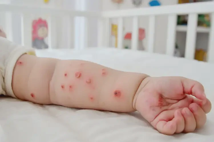 嬰兒手臂上容易起濕疹能靠自己自愈嗎(圖4)