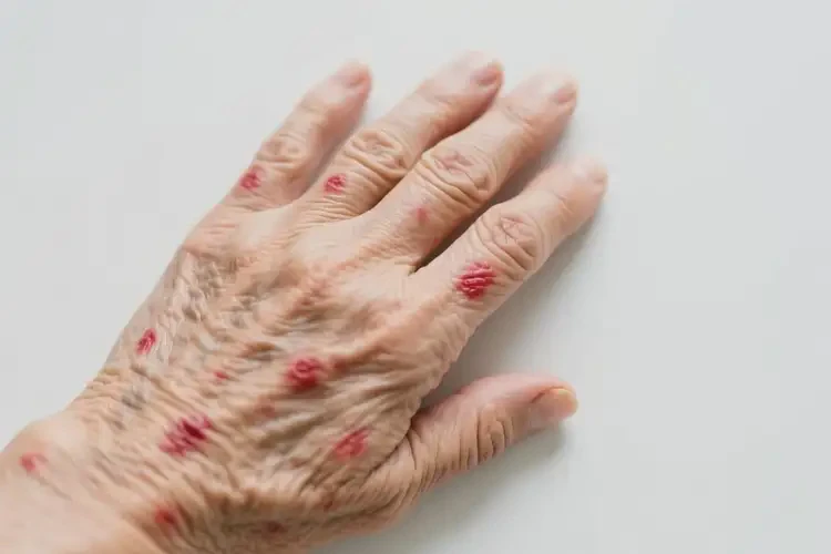 老年人全身經(jīng)常起濕疹可不可以徹底自愈(圖2)