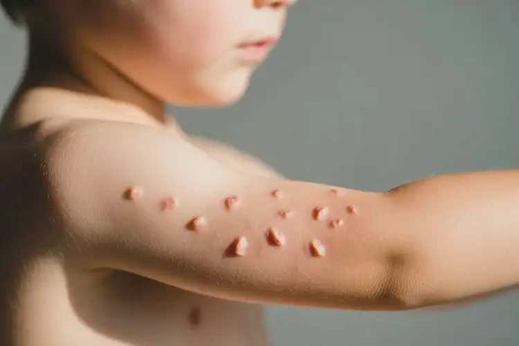 少兒手臂上容易起濕疹可不可以徹底自愈(圖1)