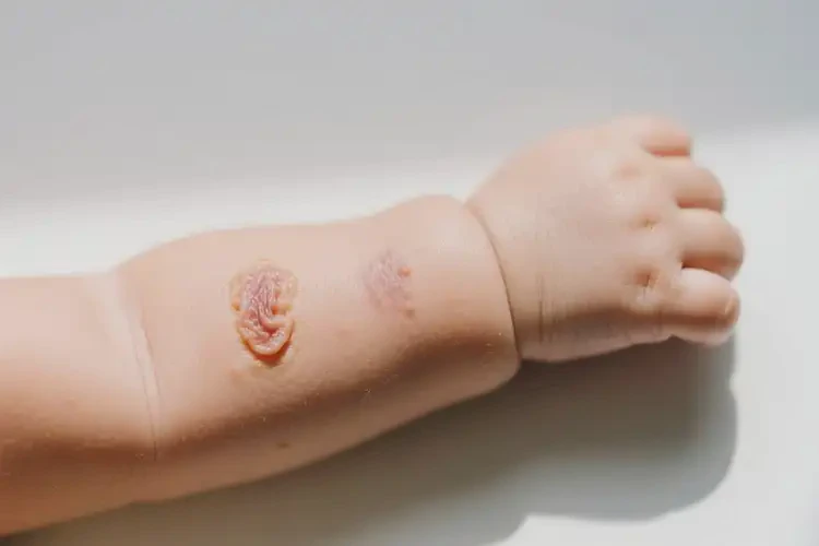 小兒身上經(jīng)常長濕疹不管它會自己痊愈嗎(圖3)