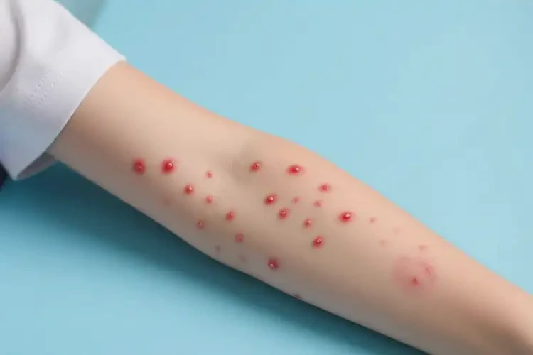 中學生手臂容易起濕疹不管它會自己痊愈嗎(圖4)