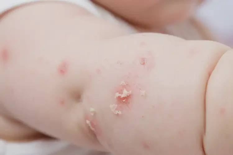 嬰幼兒手臂上起濕疹可不可以徹底自愈(圖4)