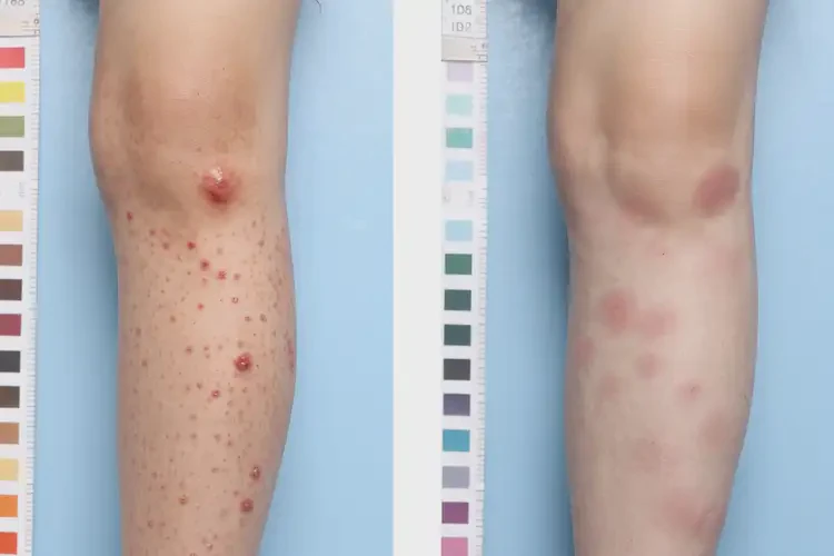 孩子大腿起濕疹可以徹底自愈嗎(圖2)