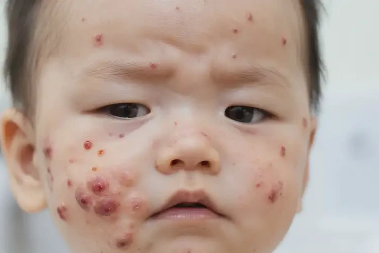 小兒面部出濕疹能靠自己自愈嗎(圖4)