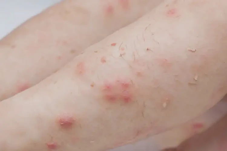 兒童小腿上出現(xiàn)濕疹可不可以徹底自愈(圖4)